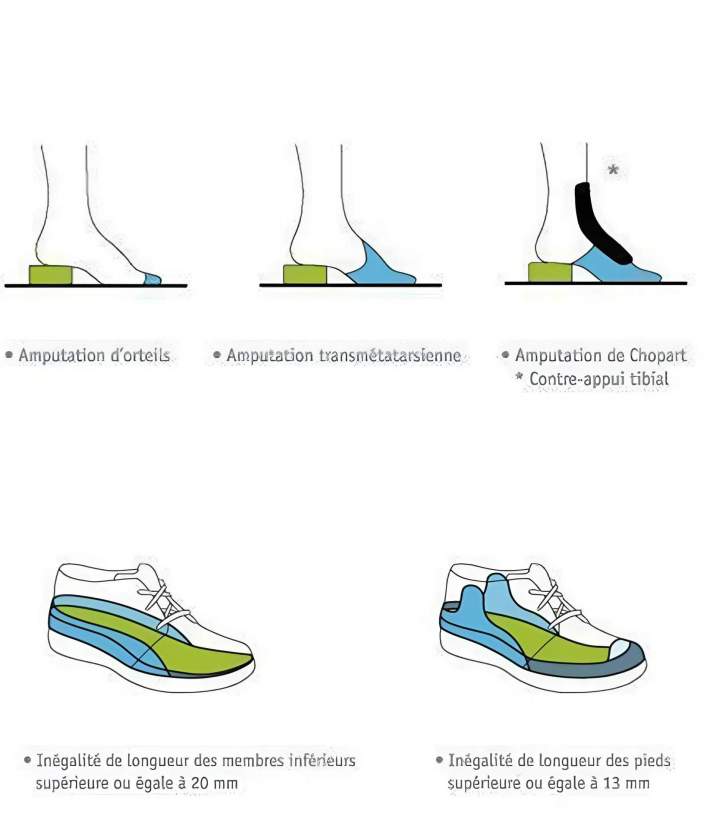 Pieds diabétique à Grand Est