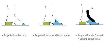 DEFICIT DES MUSCLES RELEVEURS DU PIED - Chaussures et semelles